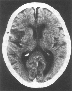 脳梗塞のＣＴ像